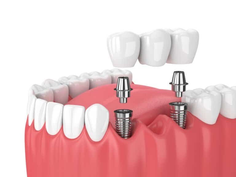 Types of Dental Implants and Their Costs at Ark Dentistry
