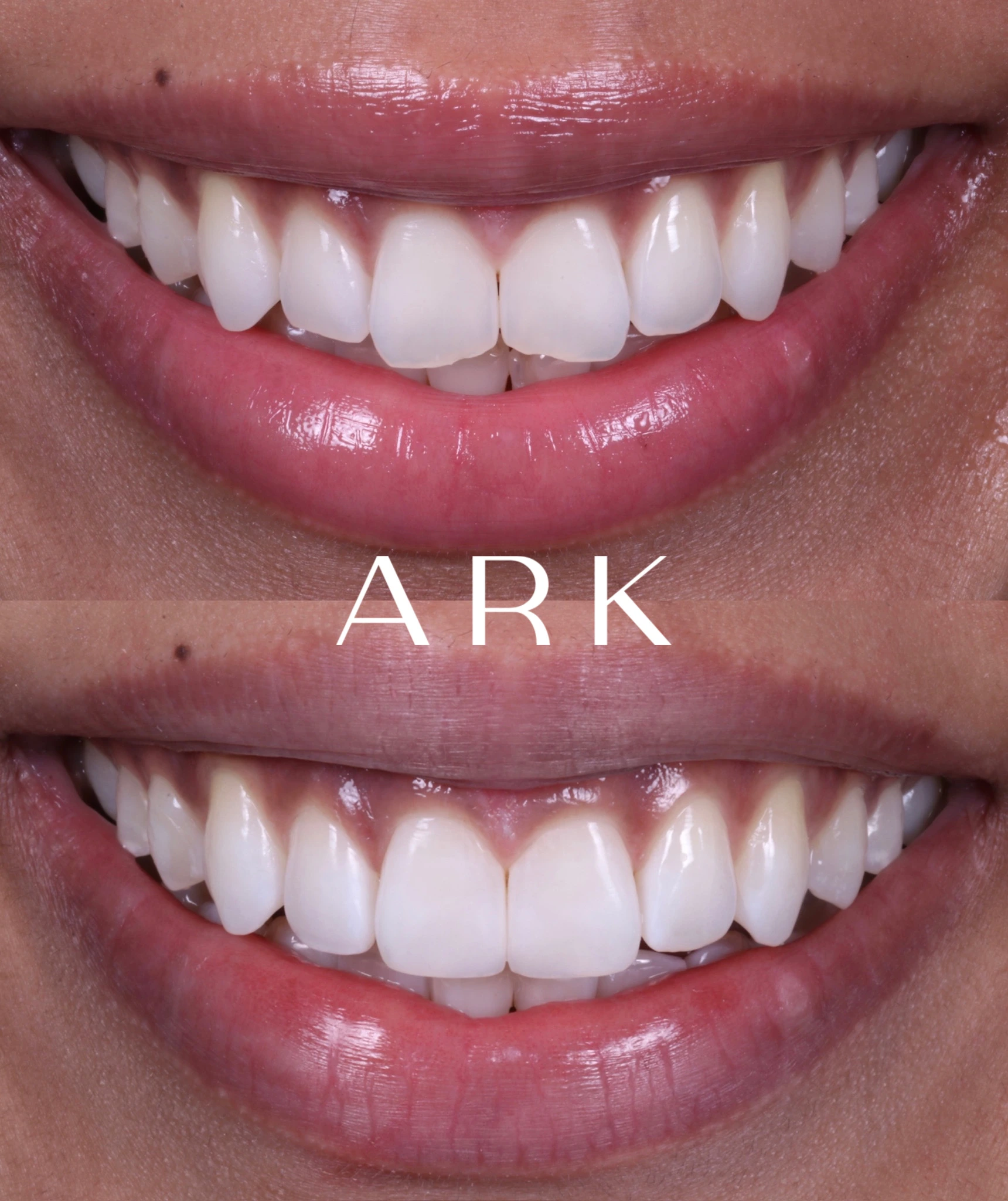 Teeth Straightening