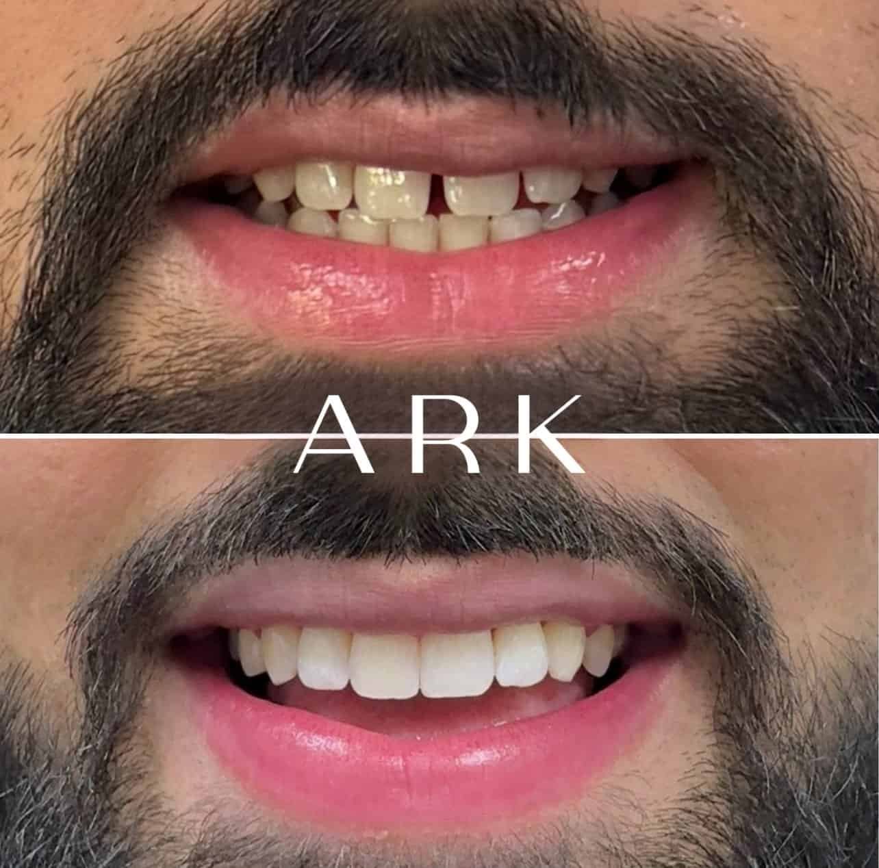 Aligners / Teeth Whitening / Edge Bonding