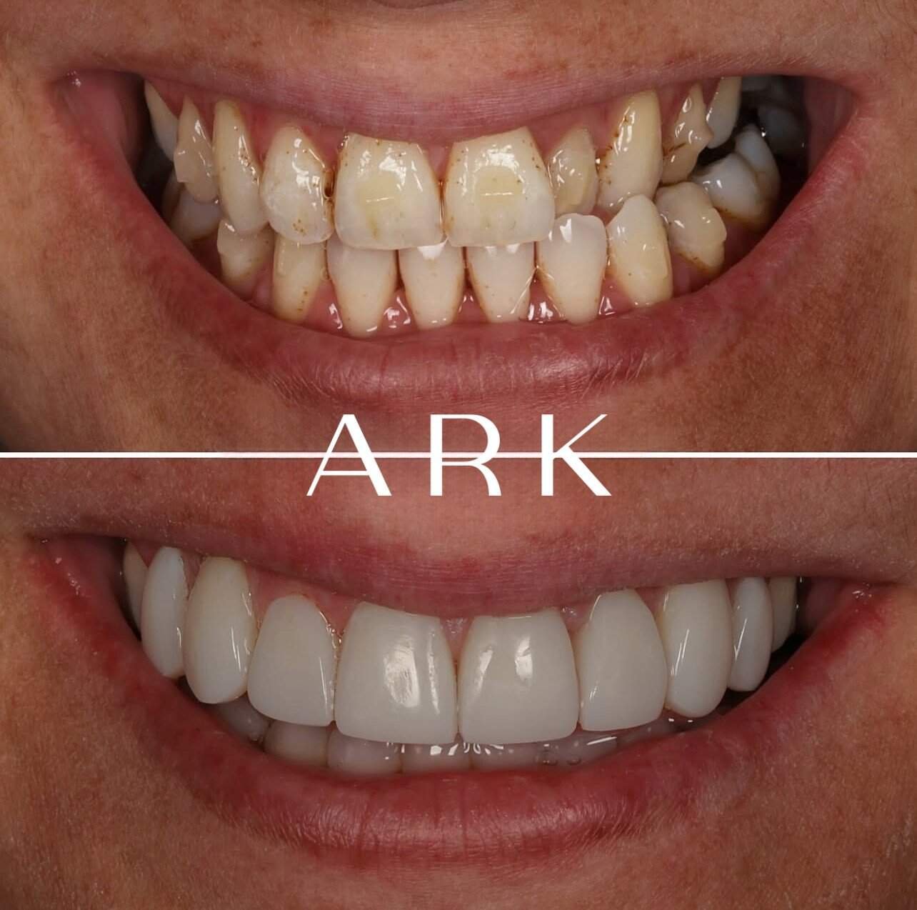 Teeth Whitening / Composite Bonding