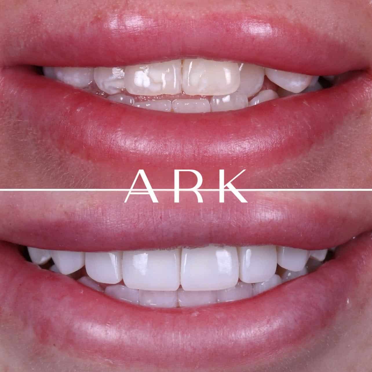 Teeth Whitening / Composite Bonding / Invisalign