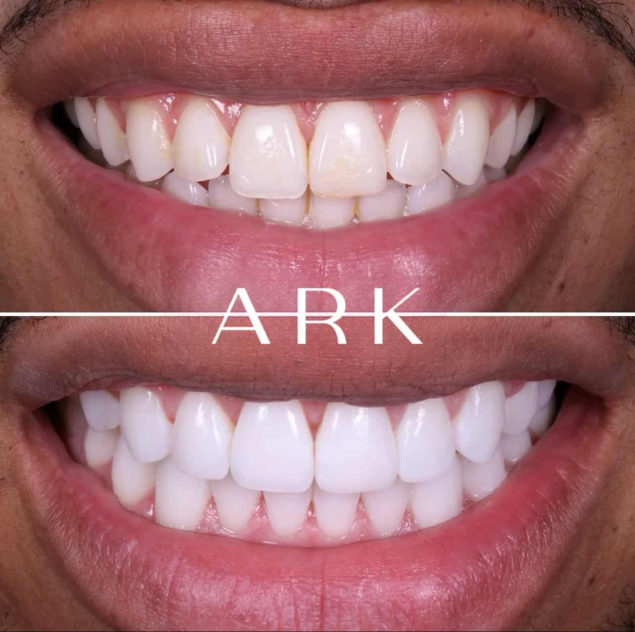 Aligners / Teeth Whitening / Minimal Bonding