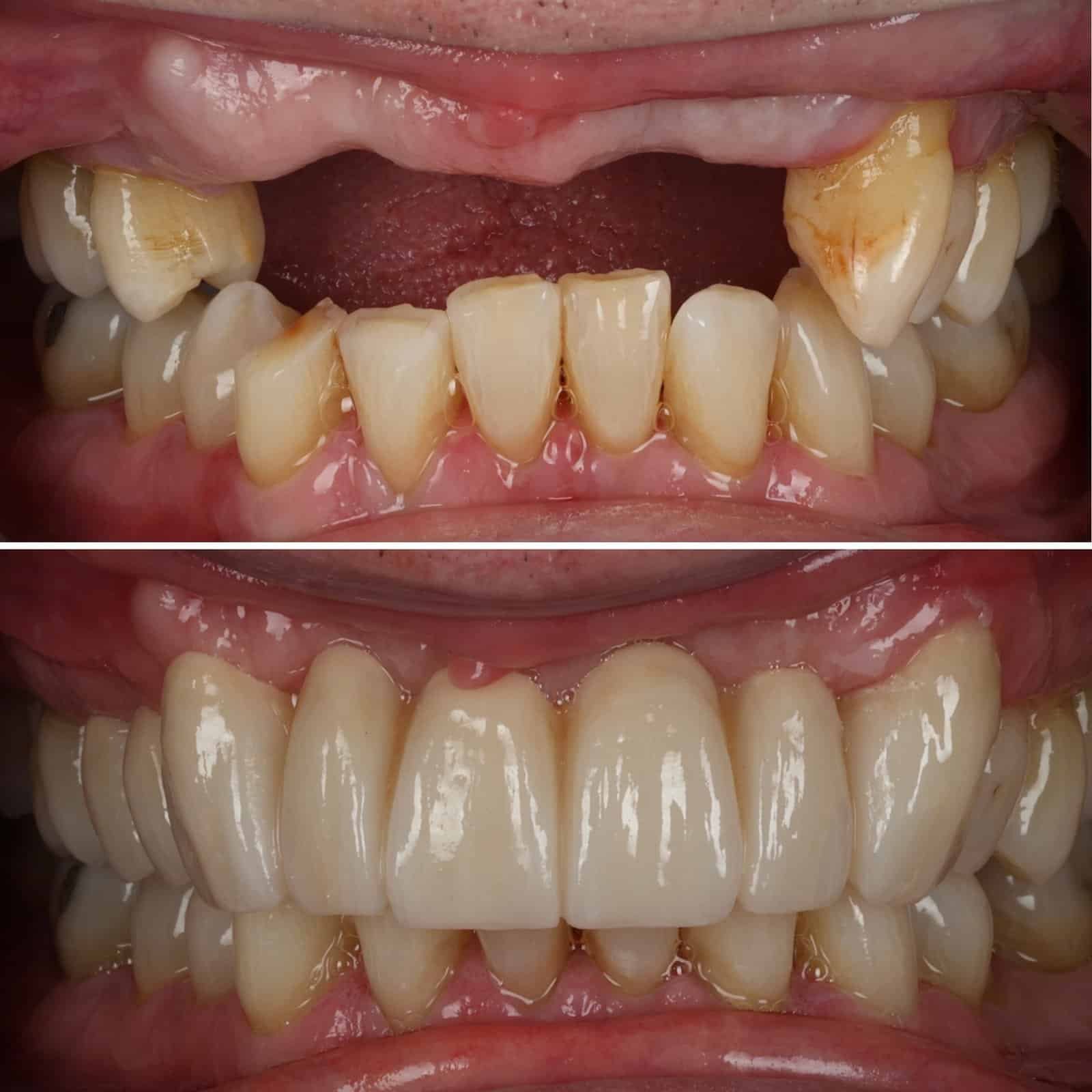 Dentures