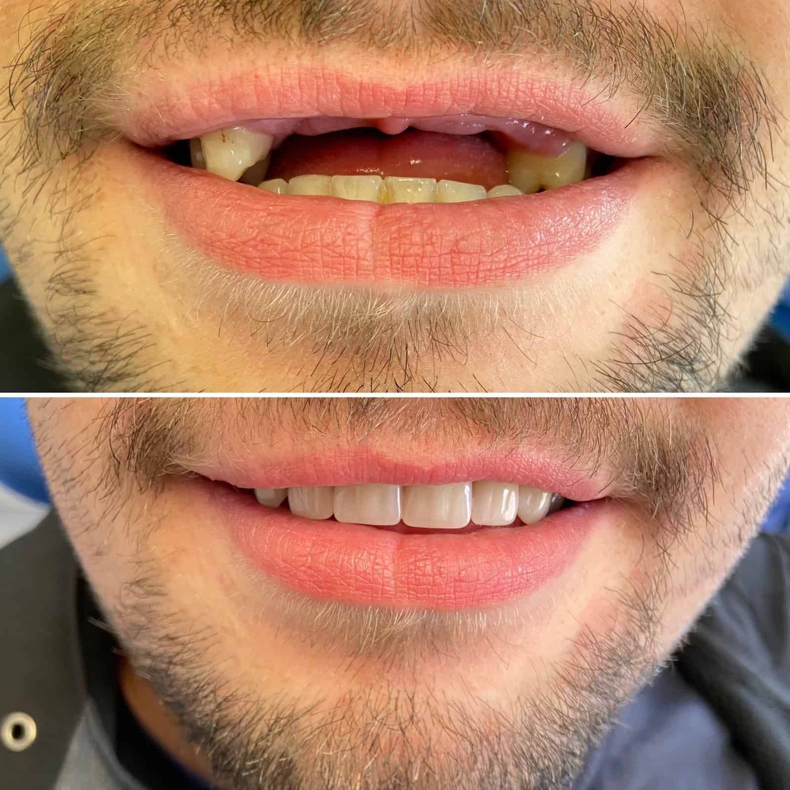 Dentures