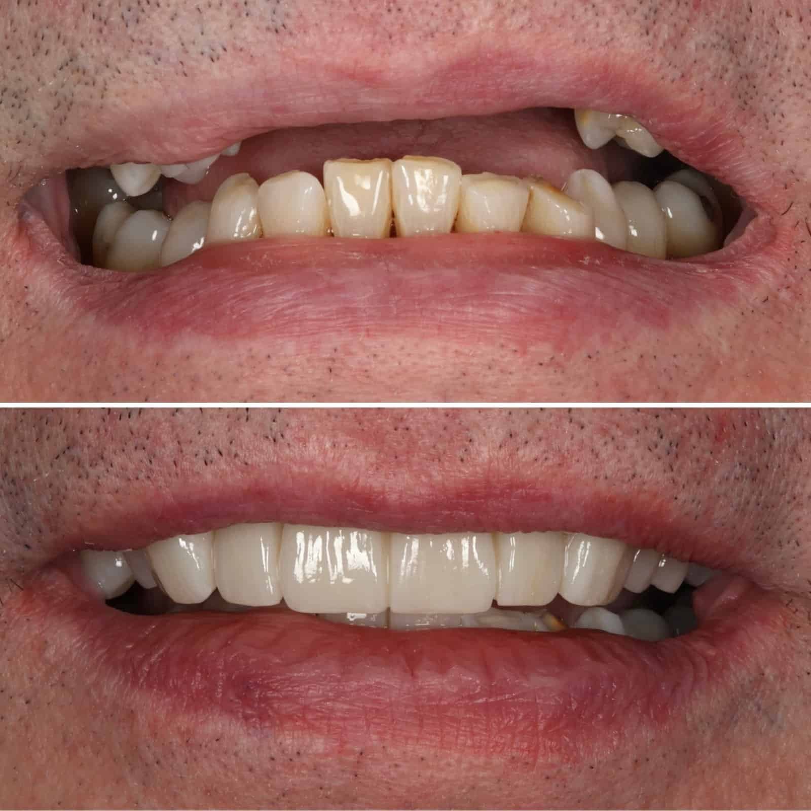 Dentures