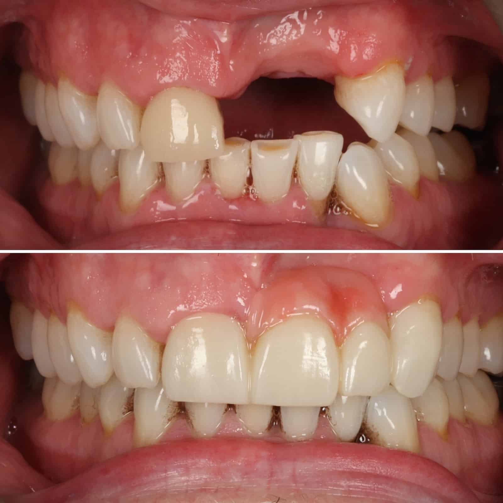 Dentures