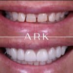 veneers