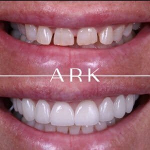 veneers