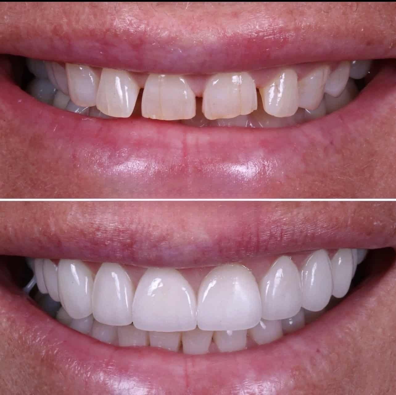 Veneers