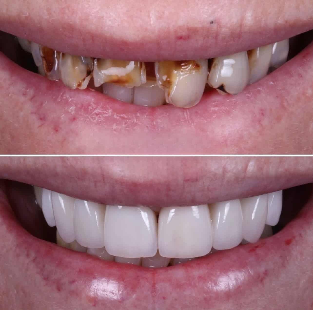Veneers