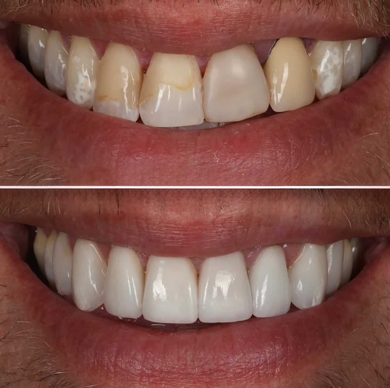 Veneers
