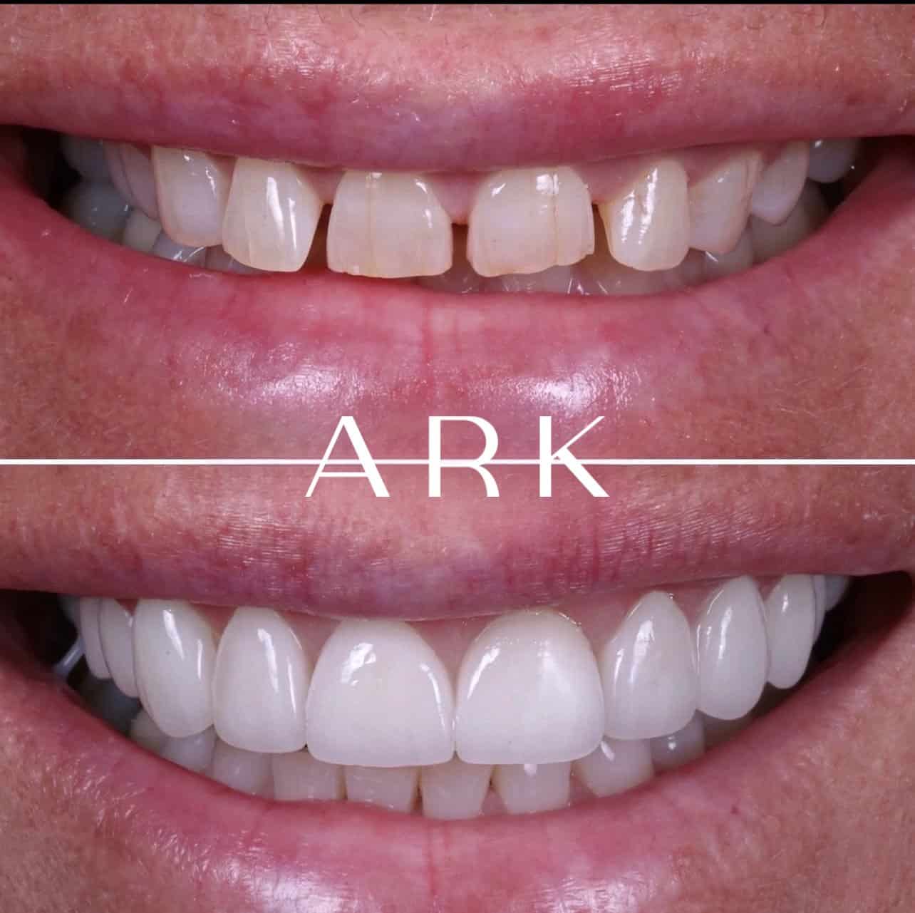 Veneers
