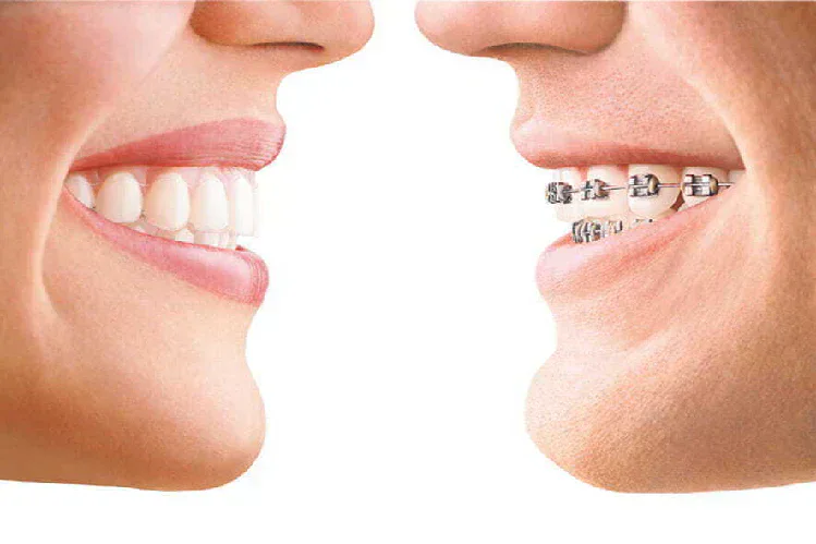 Braces vs clear Aligners