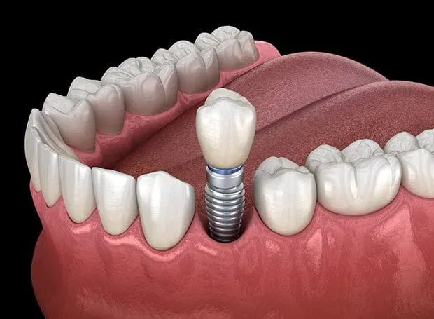 dental implants huddersfield