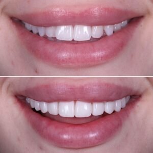 Teeth whitening