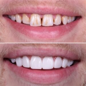 Teeth whitening