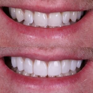 Teeth whitening