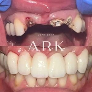 dental implants before & after