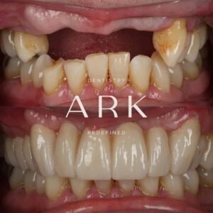 dental implants before & after