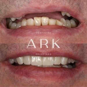 dental implants before & after