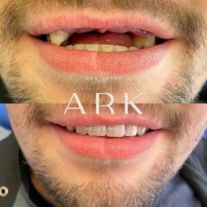 dental implants before & after