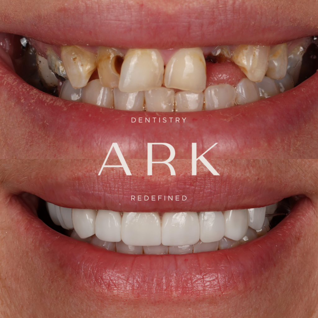 dental implants huddersfield