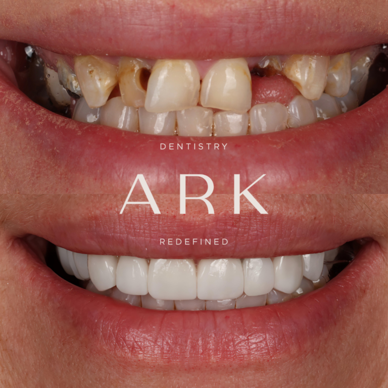 dental implants huddersfield