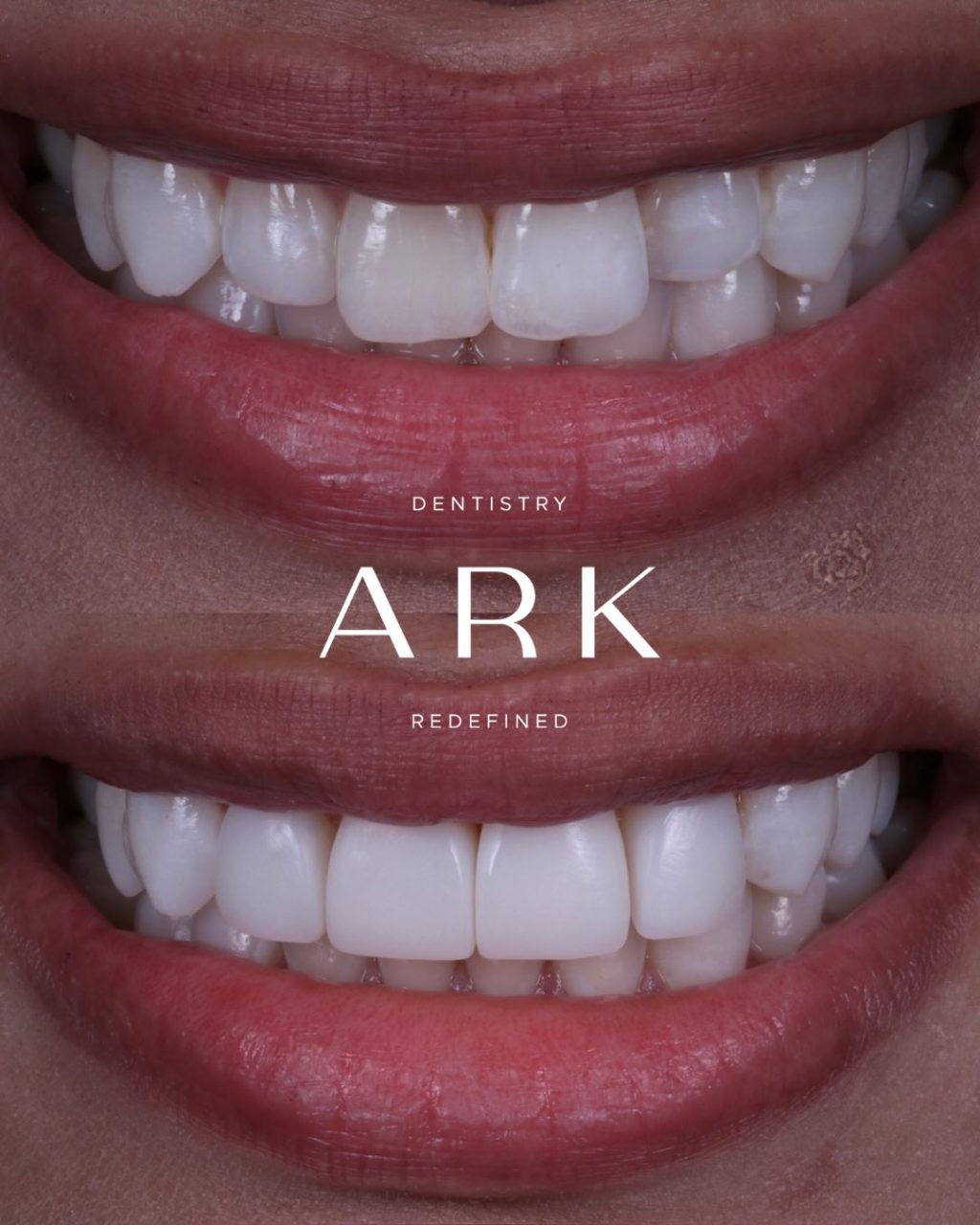 Whether you’re after subtle refinements or a more noticeable transformation, composite bonding is all about creating a smile that still feels like you. 

Each treatment is carefully tailored to the individual, focusing on balance, proportion, and results that look natural, feel comfortable and complement your unique features. 🦷✨

Ready for yours? Book in for your free consultation today!

#ArkDentistry #CompositeBonding #BeforeAndAfter #SmileTransformation