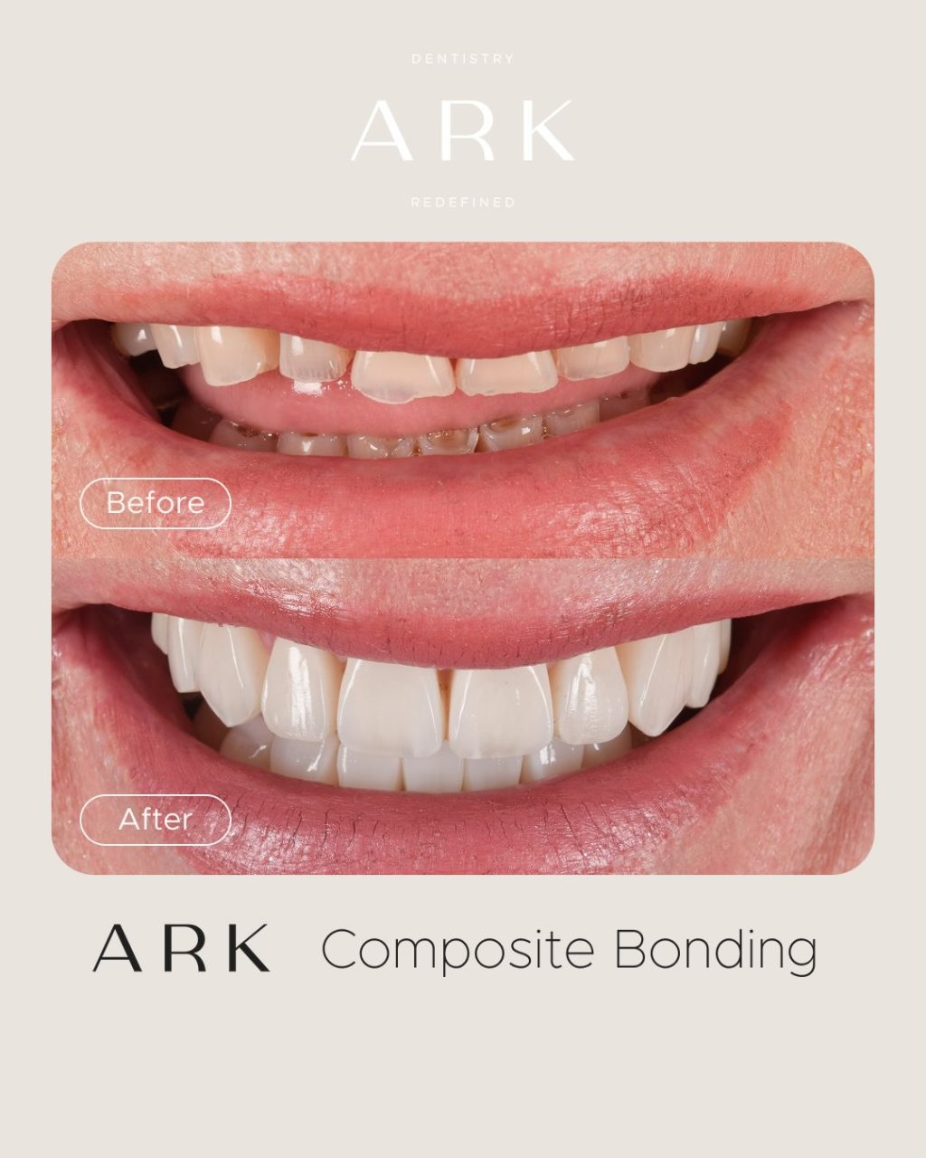 Confidence looks good on you 🦷⭐️

These Composite Bonding transformations have enhance the shape, balance and appearance of our patients’ smiles, all while keeping them beautifully natural. 

Could you be next? Book a consultation with our team today 🫵

#ArkDentistry #CompositeBonding #SmileTransformation #SmileConfidence