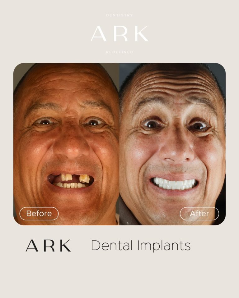 A smile can change everything 👏✨

Shane’s transformation is a reminder that Dental Implants are about more than replacing missing teeth. 

They can help restore confidence, improve quality of life, and bring back the freedom to smile without hesitation 🦷

If you’re in a similar position to Shane, this is your sign to take the first step towards your new smile! 

Drop us a DM to book a consultation today 🤍

#ArkDentistry #DentalImplants #SmileTransformation