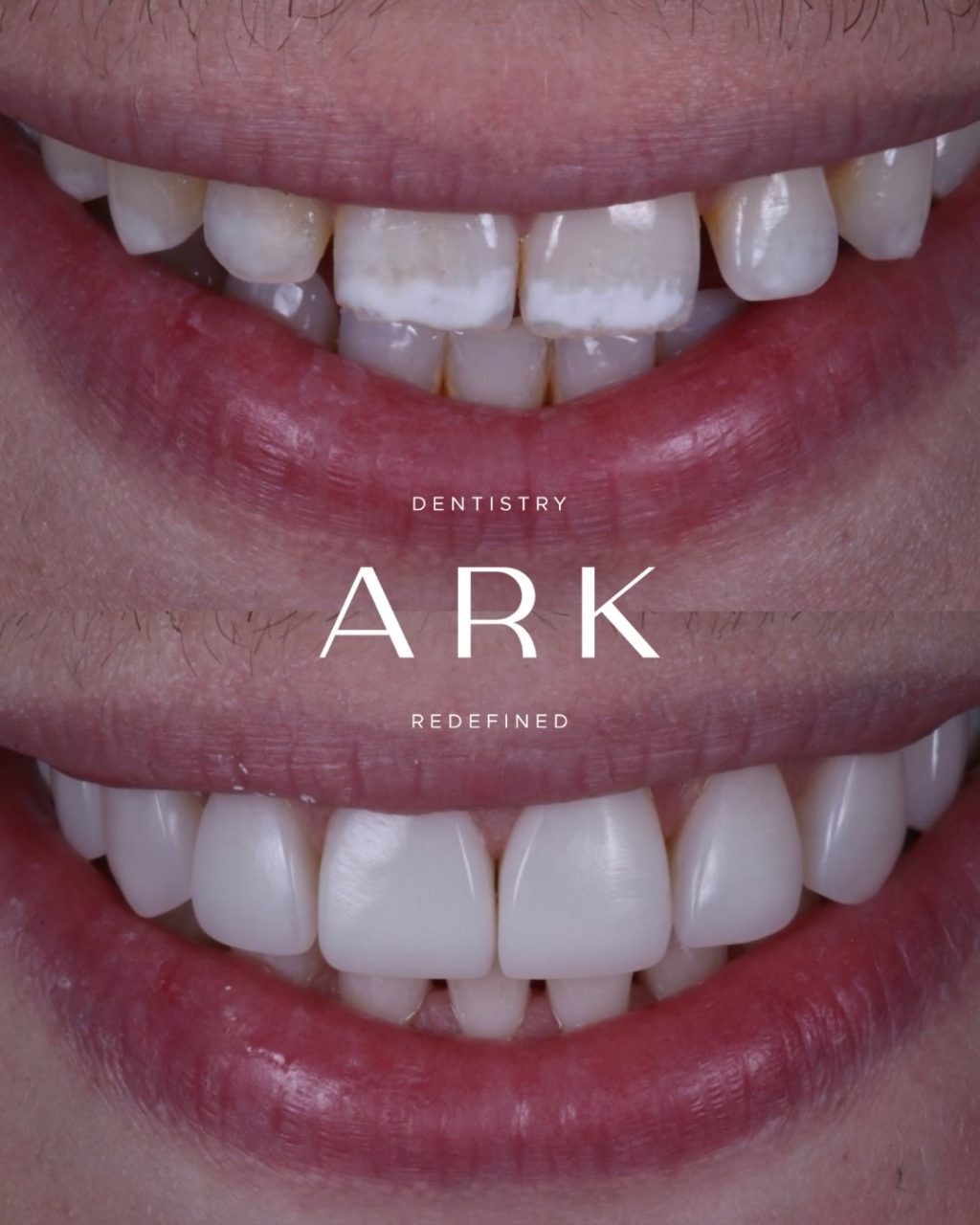 Whether you’re after subtle refinements or a more noticeable transformation, composite bonding is all about creating a smile that still feels like you. 

Each treatment is carefully tailored to the individual, focusing on balance, proportion, and results that look natural, feel comfortable and complement your unique features. 🦷✨

Ready for yours? Book in for your free consultation today!

#ArkDentistry #CompositeBonding #BeforeAndAfter #SmileTransformation