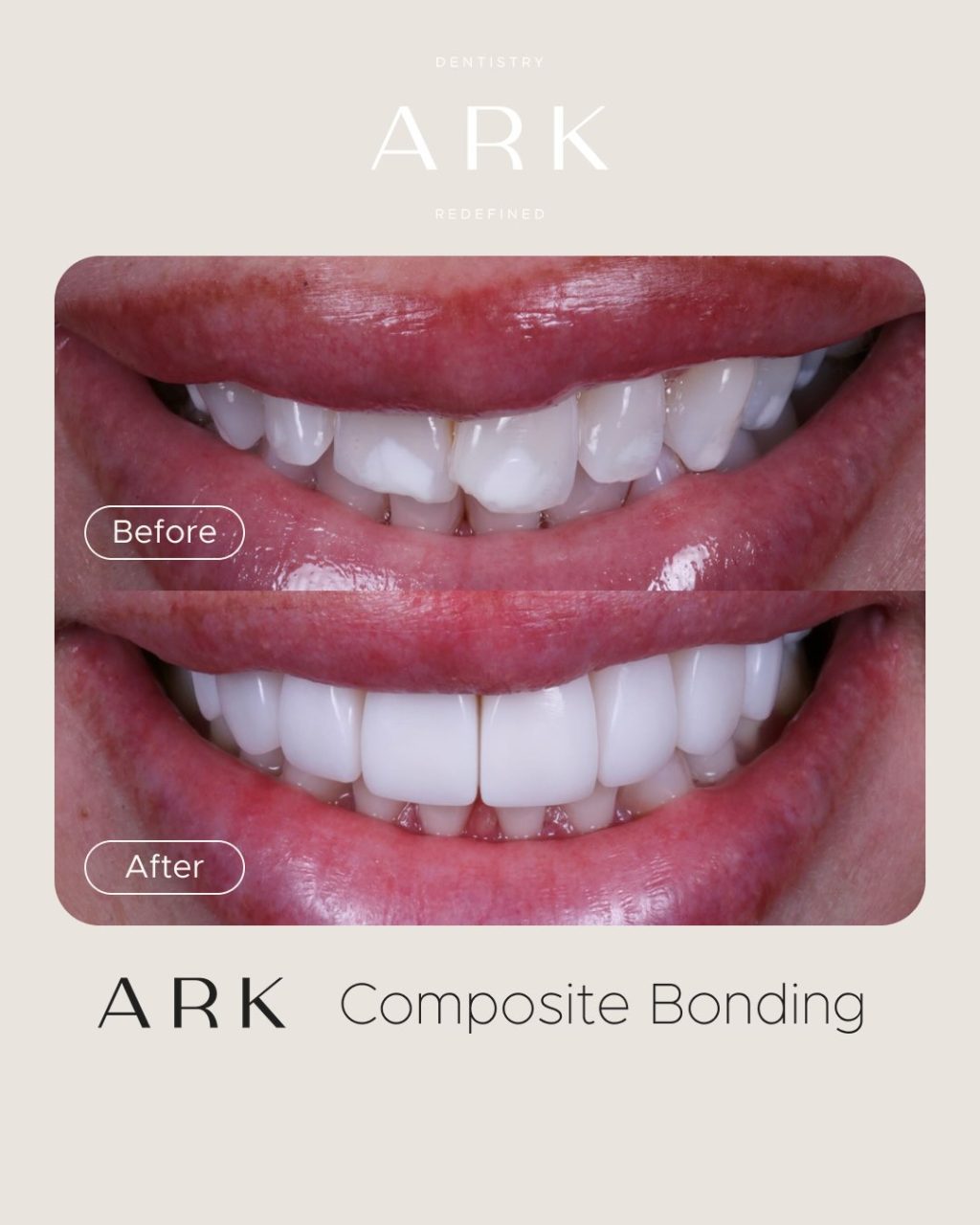 Small changes. Big transformations ✨

A beautifully refined smile starts with an understanding of shape, symmetry, proportions and the way each tooth complements the next. 

These Composite Bonding transformations were tailored to each individual smile, creating results that feel natural and uniquely yours 🤝

Ready to transform your smile? 🦷

#ArkDentistry #CompositeBonding #SmileTransformation
