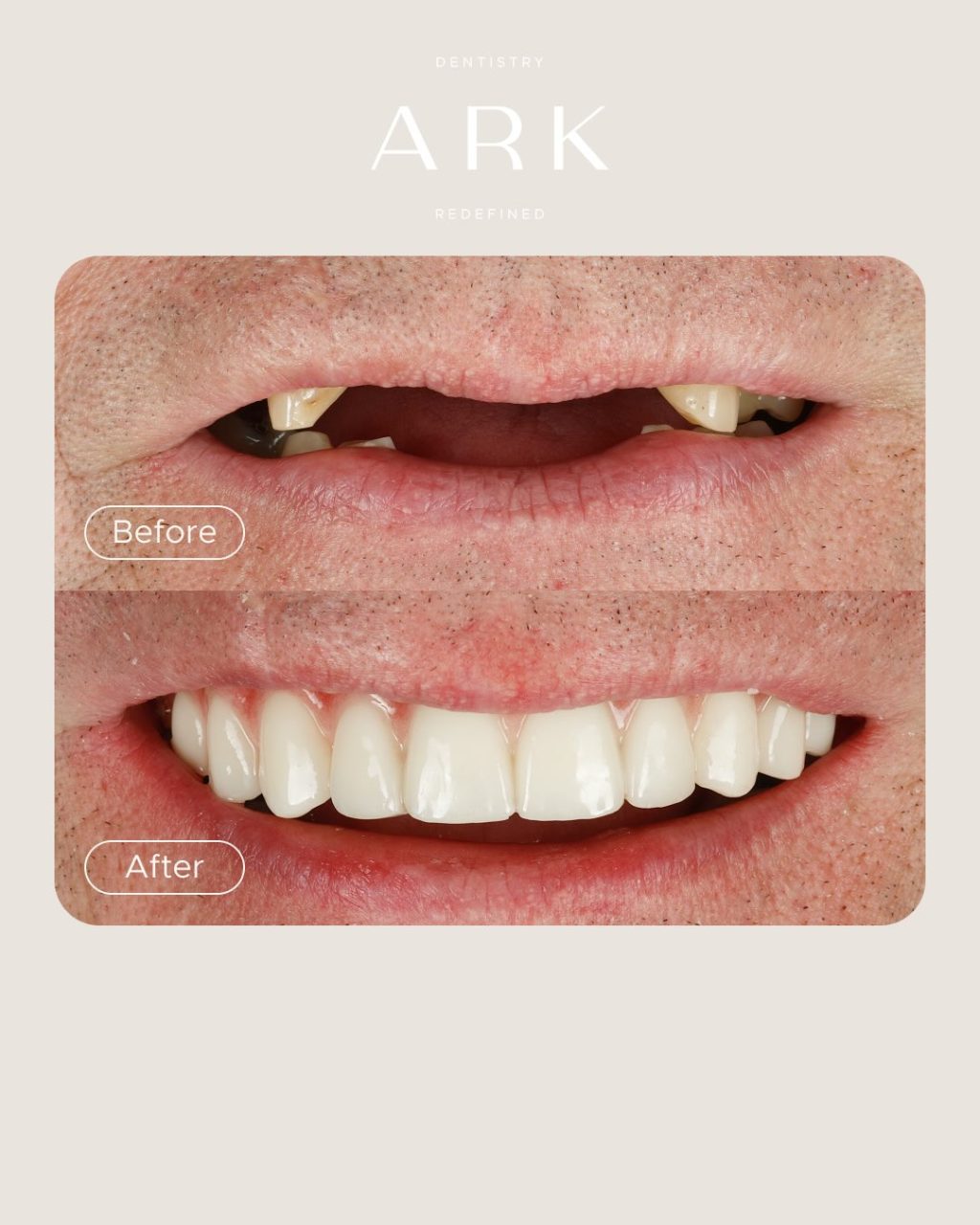 You saw the transformation, now it’s time for the close-up 👀

For Mick, this wasn’t just about replacing missing teeth, it was about getting his confidence back and improving his quality of life. 

If you’re in a similar position, this could be your sign to take the first step. Book your consultation today 🦷

#ArkDentistry #DentalImplants #SmileMakeover #TeethInADay