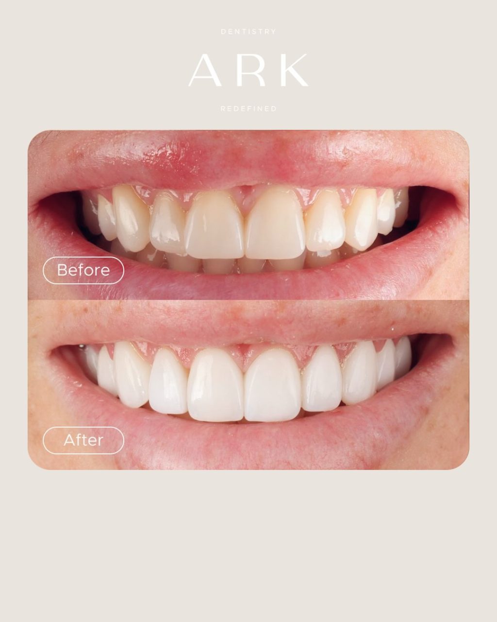 Smile transformations that speak for themselves ⭐️

Porcelain Veneers can completely transform the appearance of your smile, creating a more balanced, brighter and natural-looking finish.

From subtle enhancements to a full smile transformation, every veneer case at Ark is designed around you and your smile.

Ready to transform your smile? Tap the link in our bio to enquire today 🦷✨

#ArkDentistry #SmileTransformation #PorcelainVeneers