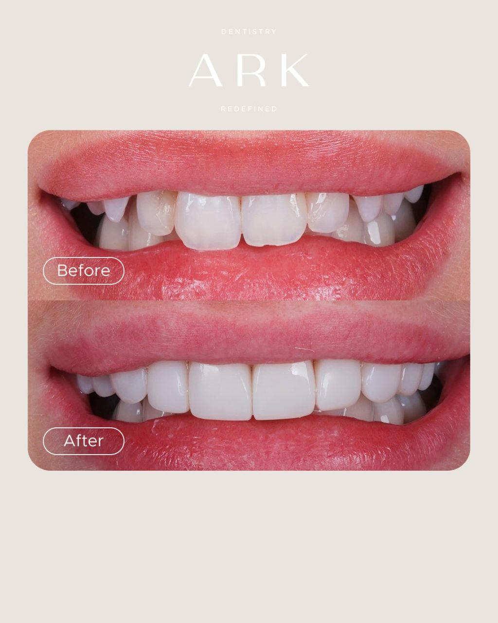 Confidence looks good on you 🦷⭐️

These Composite Bonding transformations have enhance the shape, balance and appearance of our patients’ smiles, all while keeping them beautifully natural. 

Could you be next? Book a consultation with our team today 🫵

#ArkDentistry #CompositeBonding #SmileTransformation #SmileConfidence