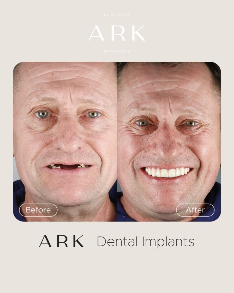 You saw the transformation, now it’s time for the close-up 👀

For Mick, this wasn’t just about replacing missing teeth, it was about getting his confidence back and improving his quality of life. 

If you’re in a similar position, this could be your sign to take the first step. Book your consultation today 🦷

#ArkDentistry #DentalImplants #SmileMakeover #TeethInADay