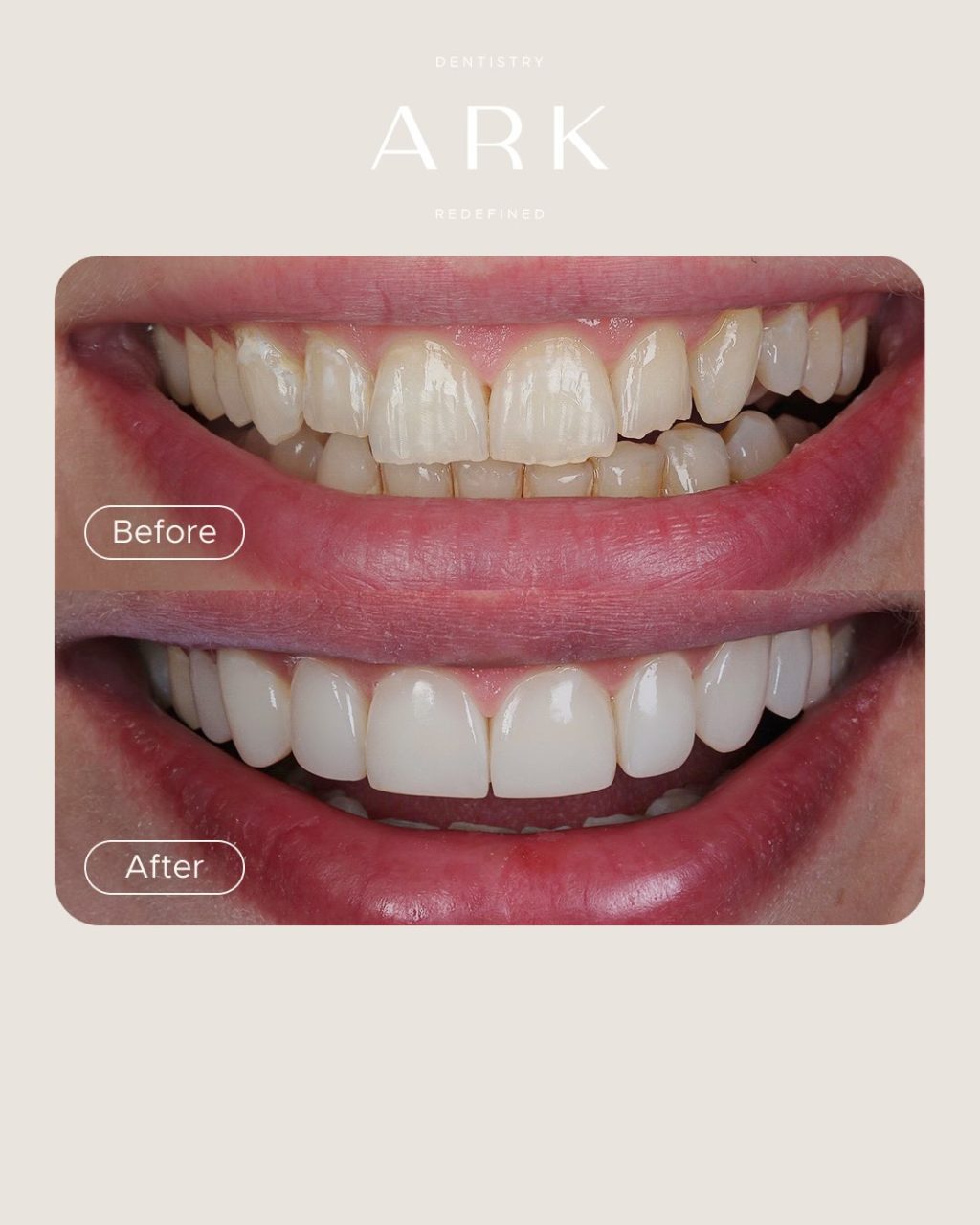 Gaps, stains or chips in your smile? 👀

Composite Bonding could be the smile transformation you’ve been looking for ✨

Using carefully sculpted composite, we can enhance the shape, colour and symmetry of your smile - creating a natural-looking result designed to you. 

Ready to transform your smile? 🦷 Drop us a DM to start your journey! 

#ArkDentistry #CompositeBonding #SmileTransformation