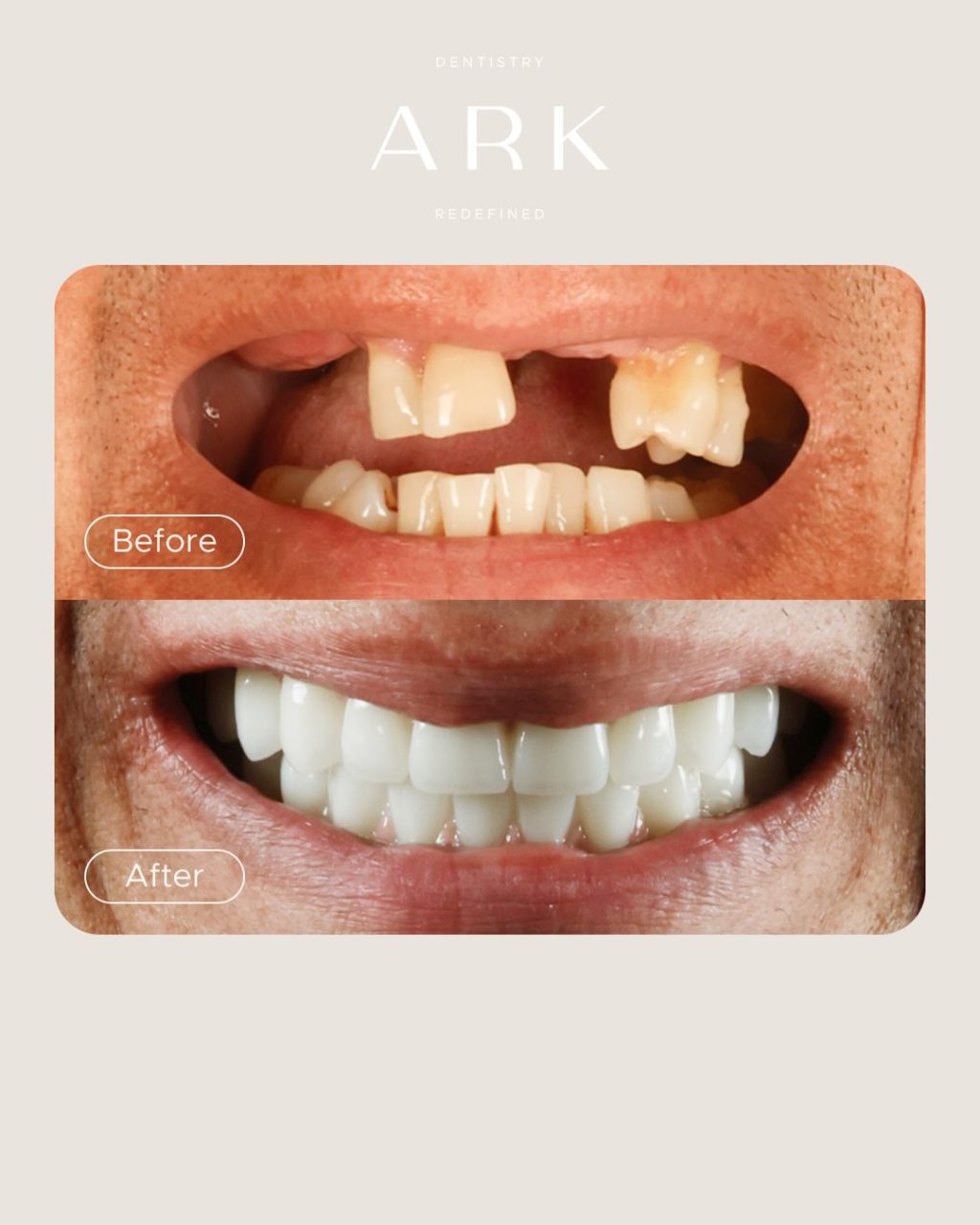 A smile can change everything 👏✨

Shane’s transformation is a reminder that Dental Implants are about more than replacing missing teeth. 

They can help restore confidence, improve quality of life, and bring back the freedom to smile without hesitation 🦷

If you’re in a similar position to Shane, this is your sign to take the first step towards your new smile! 

Drop us a DM to book a consultation today 🤍

#ArkDentistry #DentalImplants #SmileTransformation