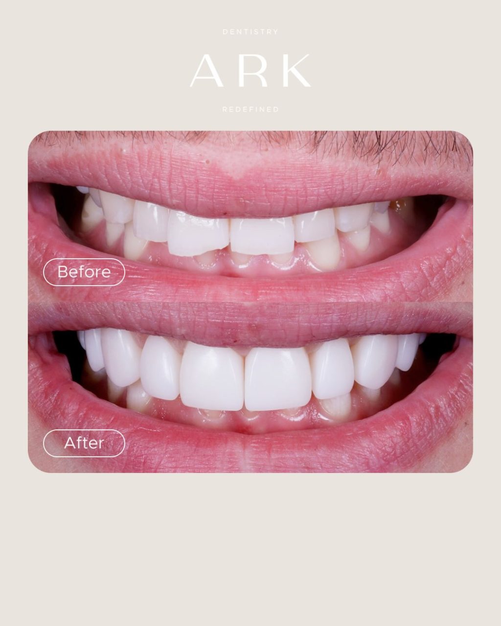 Small changes. Big transformations ✨

A beautifully refined smile starts with an understanding of shape, symmetry, proportions and the way each tooth complements the next. 

These Composite Bonding transformations were tailored to each individual smile, creating results that feel natural and uniquely yours 🤝

Ready to transform your smile? 🦷

#ArkDentistry #CompositeBonding #SmileTransformation