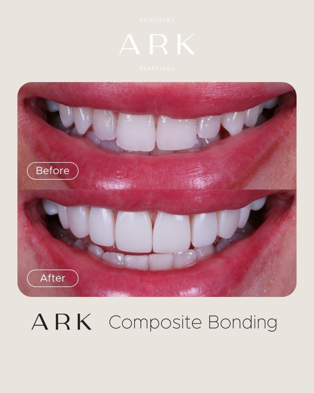 It’s all in the detail ✨

Every Composite Bonding transformation we create is tailored to the individual, taking into account tooth shape, proportions, symmetry and overall facial harmony.

The goal is never to make every smile look the same, but to create a result that feels natural, balanced and uniquely yours 🤝

Thoughtful planning. Precise artistry. Beautifully refined results 🦷

#ArkDentistry #CompositeBonding #SmileTransformation