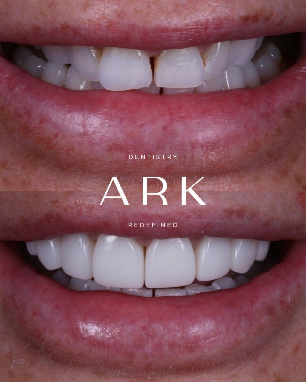 Thinking about composite bonding but unsure how it will look? 🦷

Our approach is completely bespoke, tailored to your features, preferences, and smile goals.

Bring your inspiration to your consultation, and together we’ll design a smile that feels like you! 😁