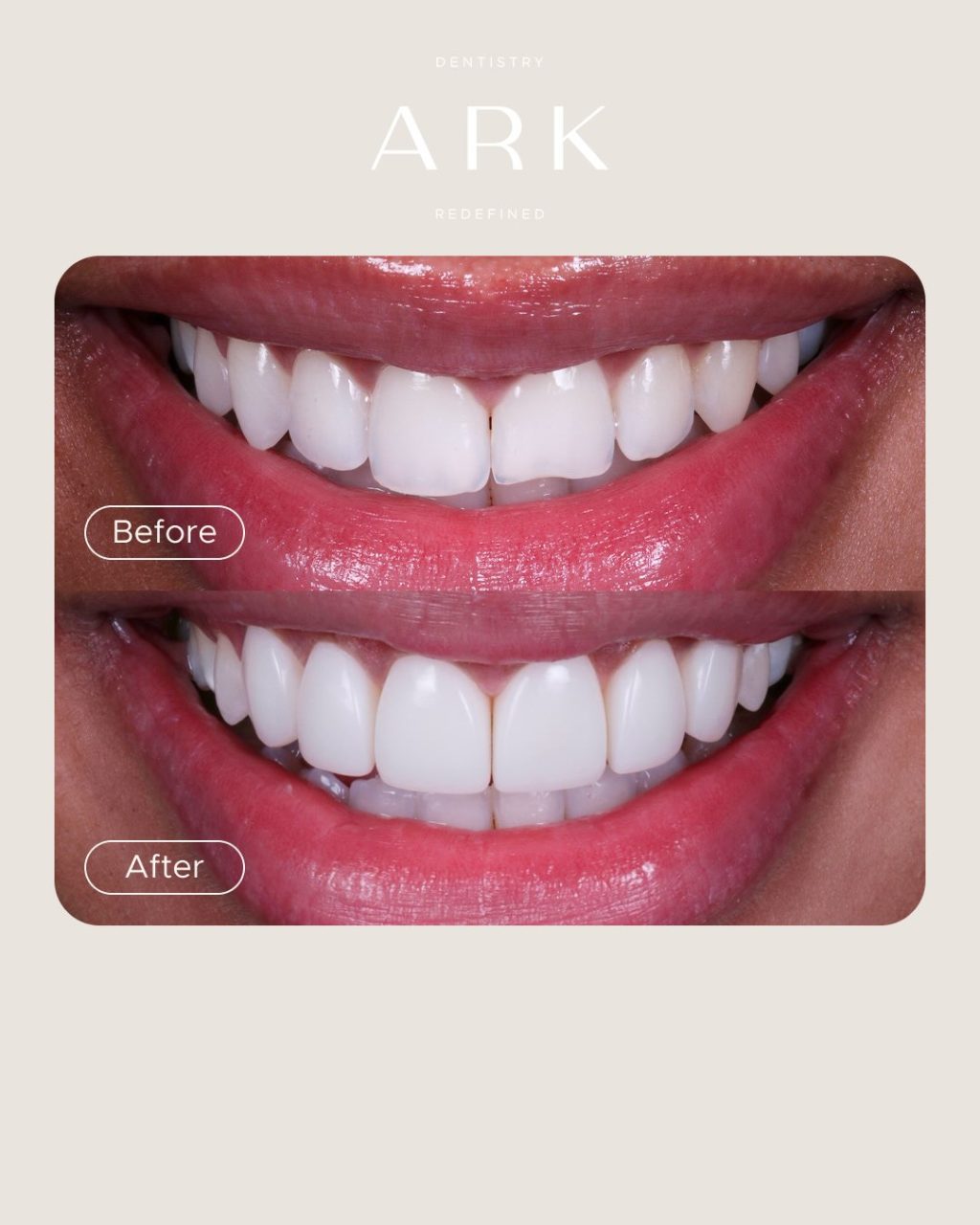 Gaps, stains or chips in your smile? 👀

Composite Bonding could be the smile transformation you’ve been looking for ✨

Using carefully sculpted composite, we can enhance the shape, colour and symmetry of your smile - creating a natural-looking result designed to you. 

Ready to transform your smile? 🦷 Drop us a DM to start your journey! 

#ArkDentistry #CompositeBonding #SmileTransformation