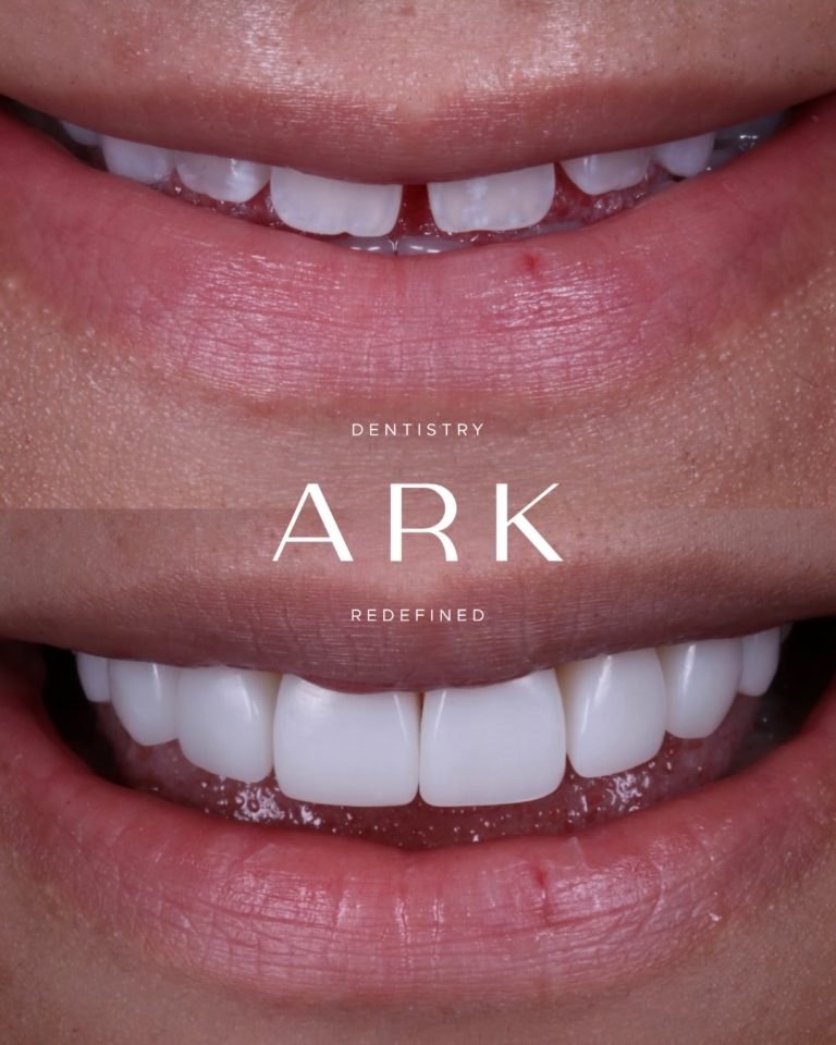 Whether you’re after subtle refinements or a more noticeable transformation, composite bonding is all about creating a smile that still feels like you. 

Each treatment is carefully tailored to the individual, focusing on balance, proportion, and results that look natural, feel comfortable and complement your unique features. 🦷✨

Ready for yours? Book in for your free consultation today!

#ArkDentistry #CompositeBonding #BeforeAndAfter #SmileTransformation