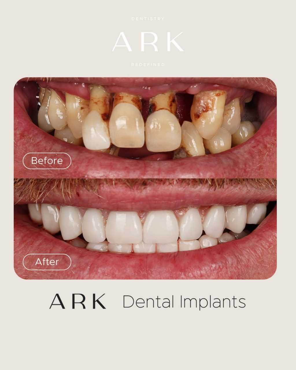 What a difference a smile can make 👏✨

From struggling with confidence to smiling without hesitation, this implant transformation has truly changed everything. 

It’s not just about replacing teeth, it’s about giving someone their life back.

If you’re in a similar position, book your consultation today and take the first step towards a smile that feels like you again 🤍

#ArkDentistry #DentalImplants #TeethInADay #SmileTransformation