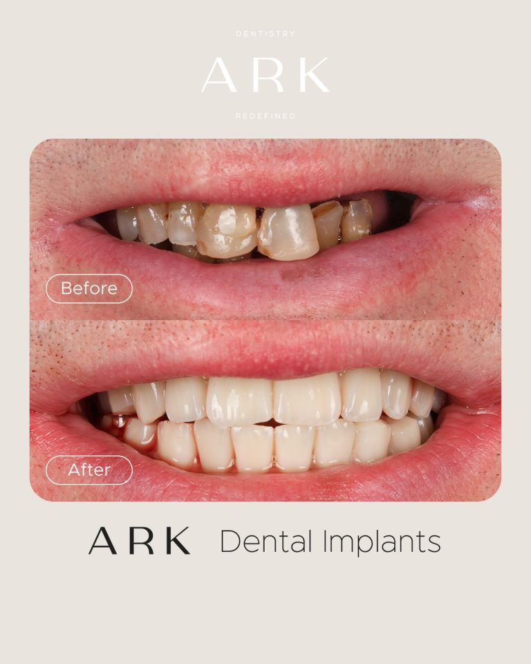 A new smile. A new chapter ✨

Dental Implants don’t just restore your smile, they restore your confidence, your ability to enjoy food and the freedom to smile without thinking twice. 

Ready to take the first step? Book your consultation with our team today 🤍

#ArkDentistry #DentalImplants #TeethInADay #SmileTransformation