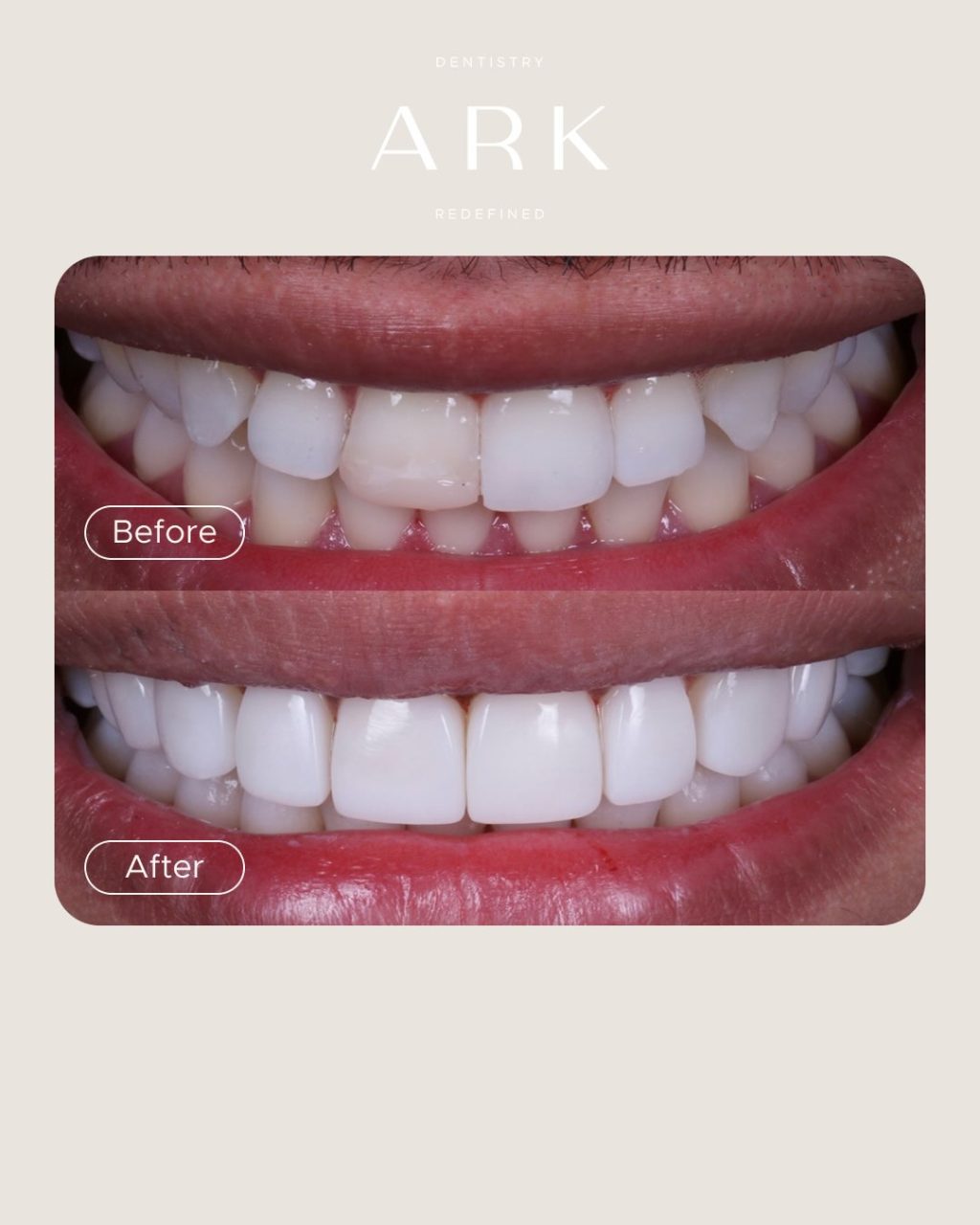 Small changes. Big transformations ✨

A beautifully refined smile starts with an understanding of shape, symmetry, proportions and the way each tooth complements the next. 

These Composite Bonding transformations were tailored to each individual smile, creating results that feel natural and uniquely yours 🤝

Ready to transform your smile? 🦷

#ArkDentistry #CompositeBonding #SmileTransformation
