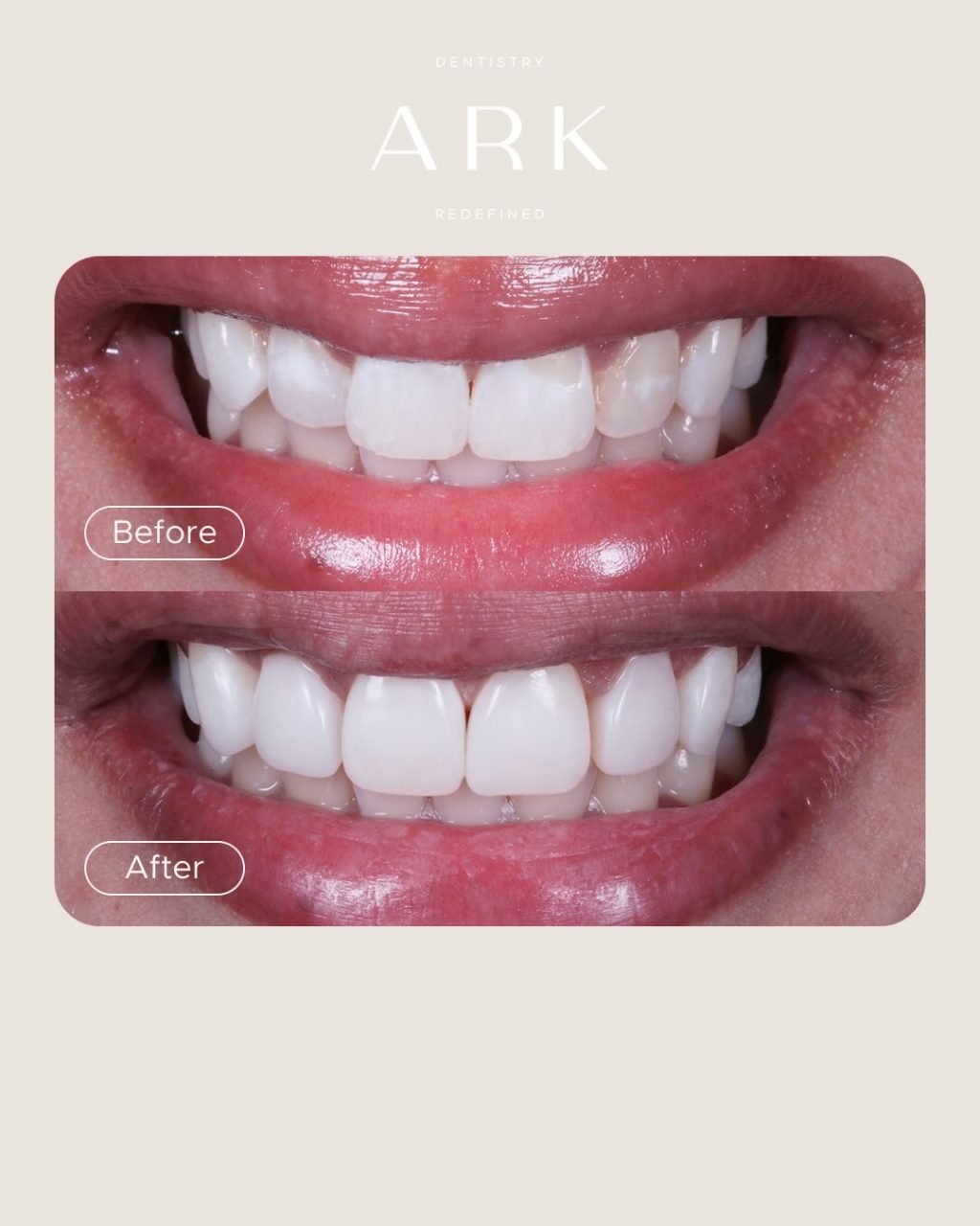 Confidence looks good on you 🦷⭐️

These Composite Bonding transformations have enhance the shape, balance and appearance of our patients’ smiles, all while keeping them beautifully natural. 

Could you be next? Book a consultation with our team today 🫵

#ArkDentistry #CompositeBonding #SmileTransformation #SmileConfidence