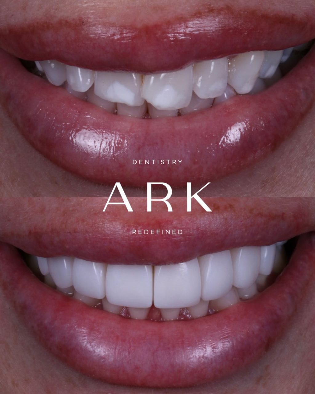 Thinking about composite bonding but unsure how it will look? 🦷

Our approach is completely bespoke, tailored to your features, preferences, and smile goals.

Bring your inspiration to your consultation, and together we’ll design a smile that feels like you! 😁
