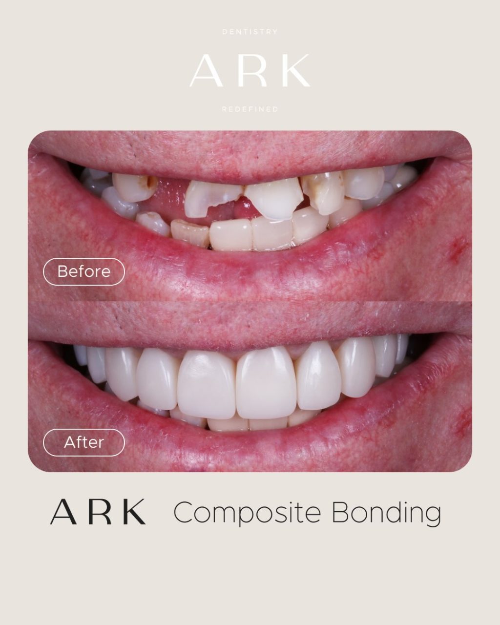 The details make the difference ✨

These Composite Bonding transformations were carefully designed to enhance the natural shape and proportions of each smile, creating results that feel seamless, balanced and completely bespoke 🤝

Your smile. Redefined by Ark Dentistry 🦷

#ArkDentistry #CompositeBonding #BeforeAndAfter #SmileTransformation