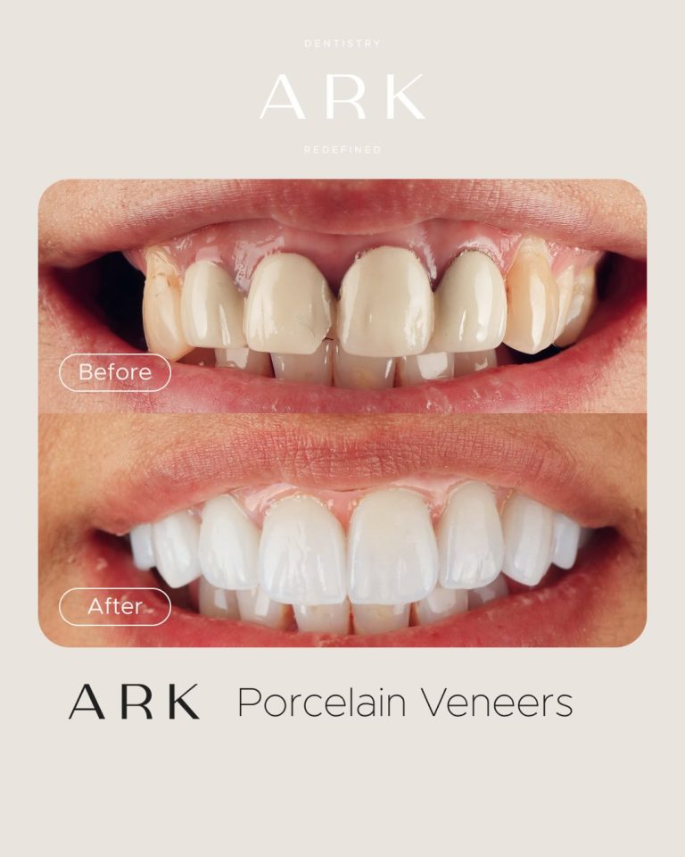 Smile transformations that speak for themselves ⭐️

Porcelain Veneers can completely transform the appearance of your smile, creating a more balanced, brighter and natural-looking finish.

From subtle enhancements to a full smile transformation, every veneer case at Ark is designed around you and your smile.

Ready to transform your smile? Tap the link in our bio to enquire today 🦷✨

#ArkDentistry #SmileTransformation #PorcelainVeneers